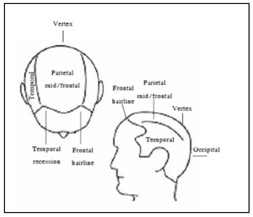 บริเวณอาการของ หัวล้านชาย