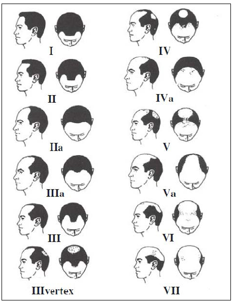 รูปแบบของ หัวล้านชาย ในแต่ละช่วง